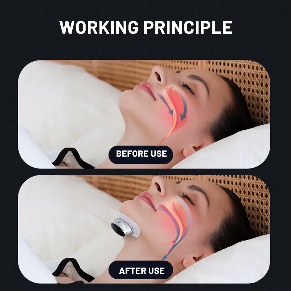 Smartsnore™ 5-Pair EMS Anti-Snoring Device – Breathe Easy, Sleep Deep